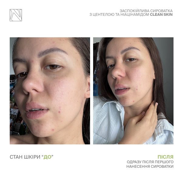 ЗАСПОКІЙЛИВА СИРОВАТКА З ЦЕНТЕЛОЮ ТА НІАЦИНАМІДОМ CLEAN SKIN SERUM